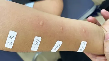 急増中【ナッツアレルギー】原因や対策について専門医に聞いた！スキンケアが予防のカギ 